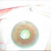 ΙΚ1 ΜΙΚΡΗ ΚΟΡΗ ΛΕΥΚΟΣ ΚΑΤΑΡΡΑΚΤΗΣ ΜΕ ΤΡΑΥΜΑΤΙΚΗ ΡΗΞΗ ΟΠ ΠΕΡΙΦΑΚΙΟΥ ΑΠΟ ΕΓΧΥΣΗ ΑΝΤΙVGEF ΠΑΡΑΓΟΝΤΑ