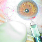 Τομή Κερατοειδούς