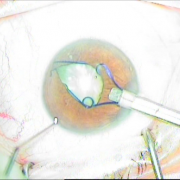 ΕΝΘΕΣΗ ΔΙΑΣΤΟΛΕΑ ΙΡΙΔΟΣ