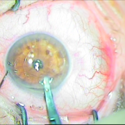 Ένθεση Φακού