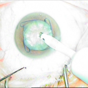 ΦΑΚΟΘΡΥΨΙΑ