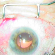 Μεταγχειριτική παρεκτόπιση ενδοφακού sun set syndrome