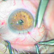 Συρραφή Τομής