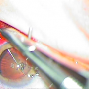 Τραυματική διάσπαση ζίνειου ζώνης 5 ωρών