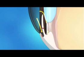 Περιφερική Ιριδεκτομή