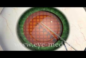 Επέμβαση καταρράκτη με LASER