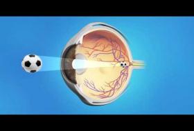 Θόλωση Οπισθίου Περιφακίου