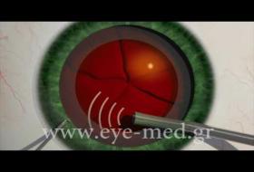 Επέμβαση Καταρράκτη με υπερήχους (ή φακοθρυψία)